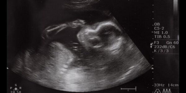 Jak przebiegają kroczki badania prenatalnego?